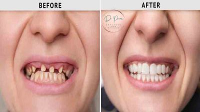 A Brand New Smile Awaits: Rediscover Confidence with Dental Implants! (Doctorprem)